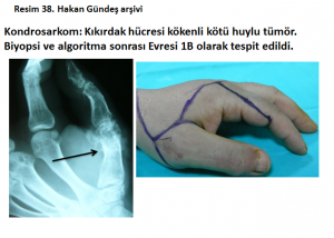 kemik-hucre-tumor