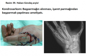 kemik-hucre-tumorleri