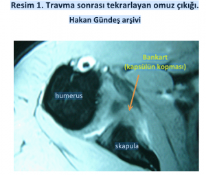 omuz-agrisi