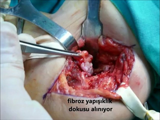 Kübital Tünel Sendromu Cerrahi Tedavi