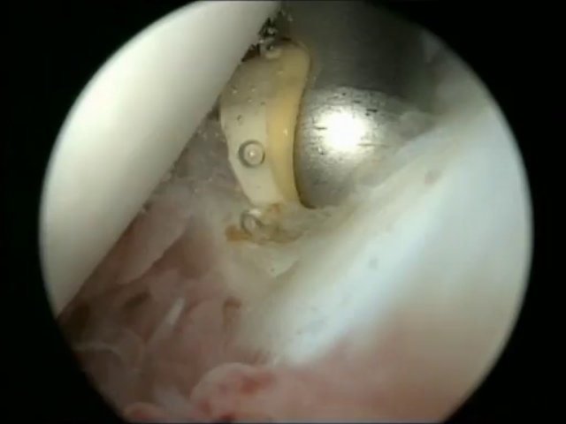 Omuz Artroskopi Akromio-Klavikular Çıkık / AC Dislocation Arthroscopic Surgery