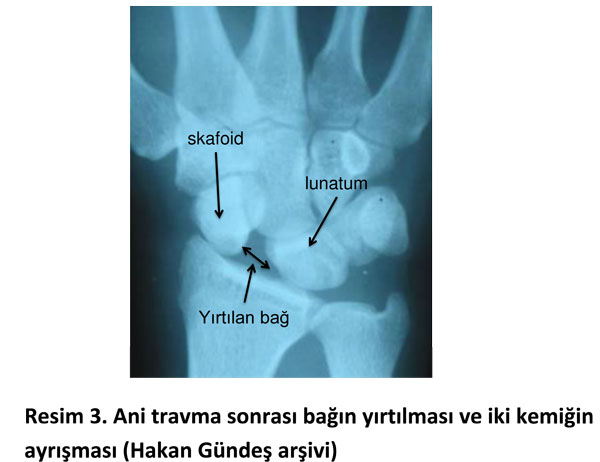 bag-yirtilmasi-el-bilek