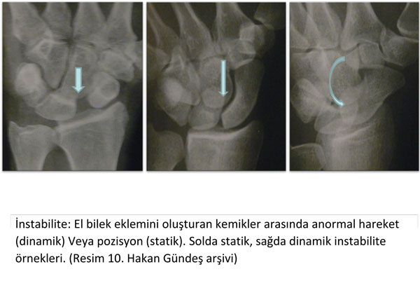 el-bilek-a-r-s-instabilite-10