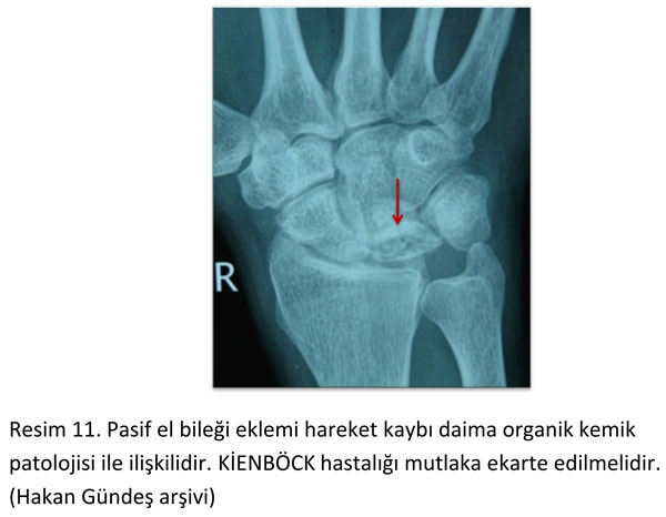 el-bilek-a-r-s-instabilite-11