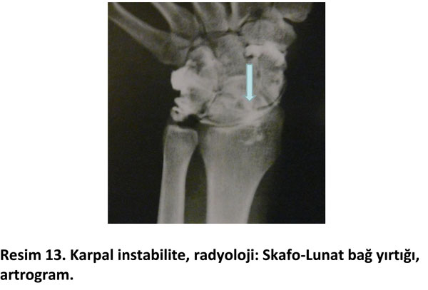 el-bilek-a-r-s-instabilite-13