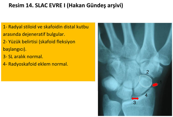 el-bilek-a-r-s-instabilite-14