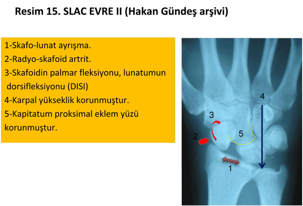el-bilek-a-r-s-instabilite-15