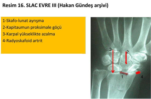 el-bilek-a-r-s-instabilite-16