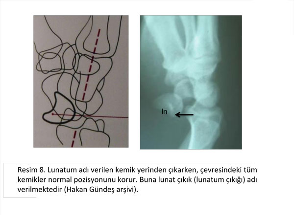 el-bilek-a-r-s-instabilite-8