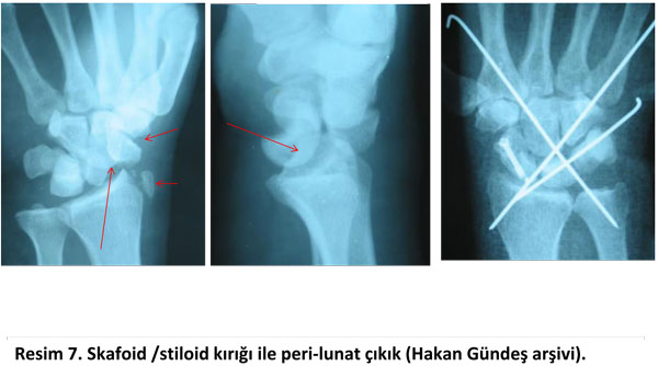 el-bilek-tedavi-hastalik